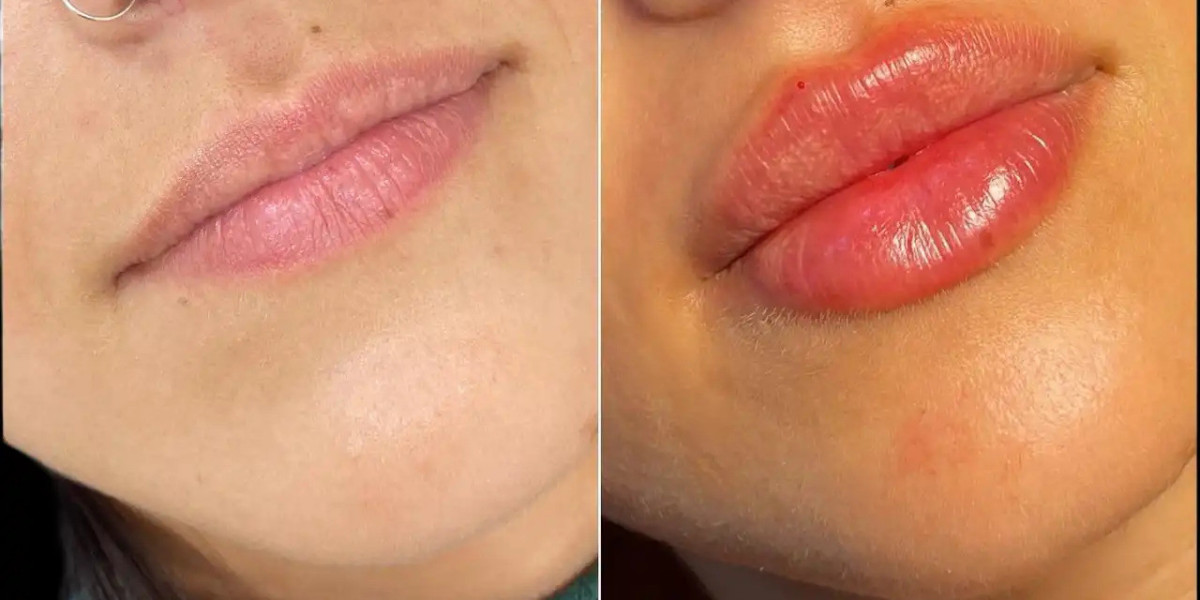Dermal Fillers in Dubai for Improved Facial Symmetry