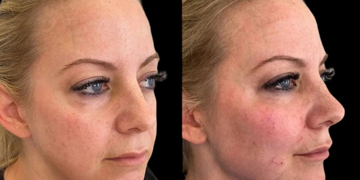 Cheek Fillers in Dubai Why Celebrities Prefer Non-Surgical Treatments