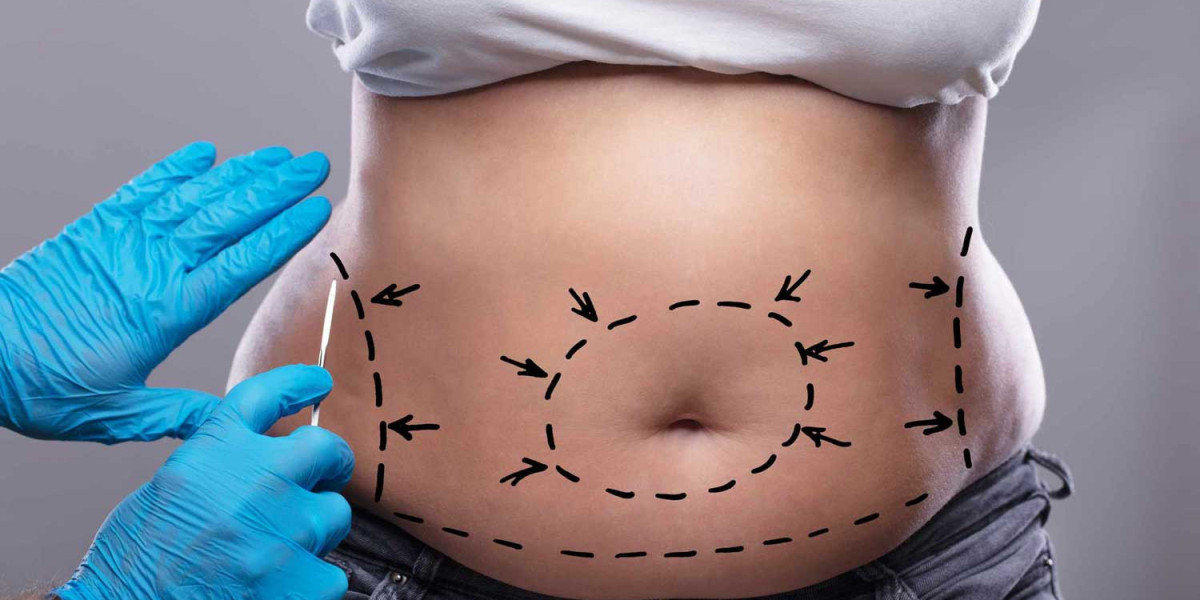 Tummy Tuck Consultation in Dubai: Questions to Ask Your Surgeon