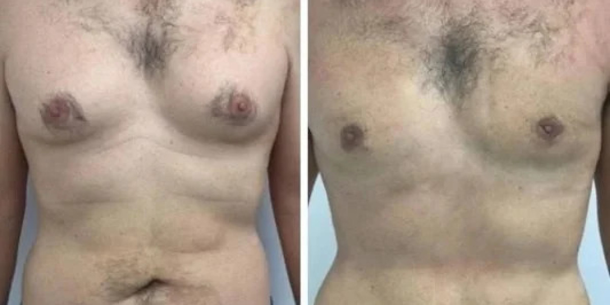 Gynecomastia in Dubai: Precision in Treatment