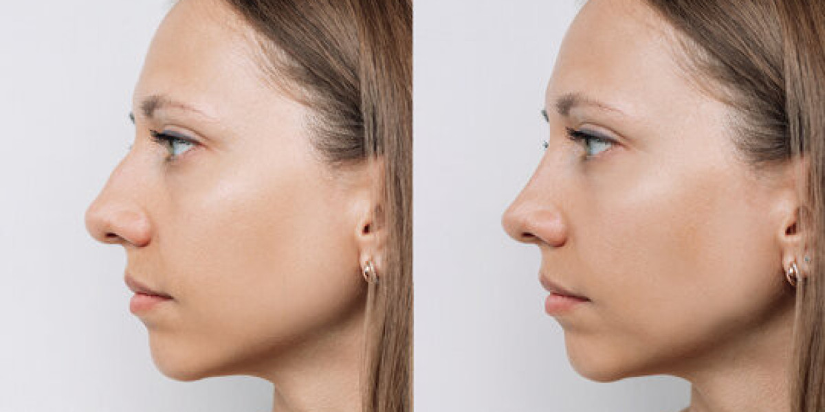 A Closer Look at the Factors That Shape Your Rhinoplasty Treatment Plan