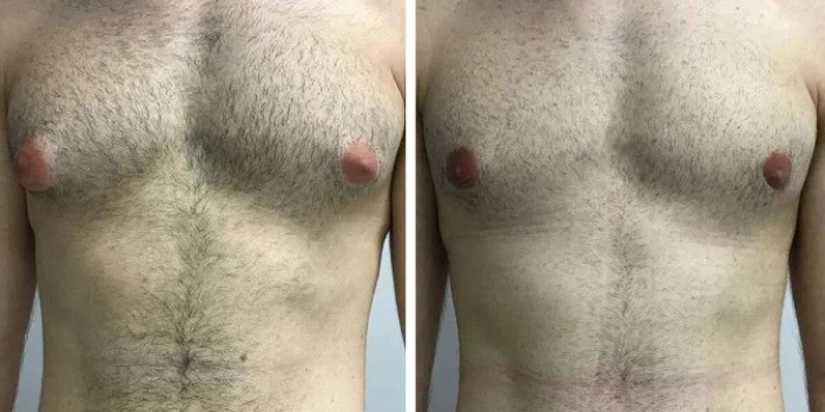 How Gynecomastia Surgery in dubai Assesses Chest Skin Redundancy
