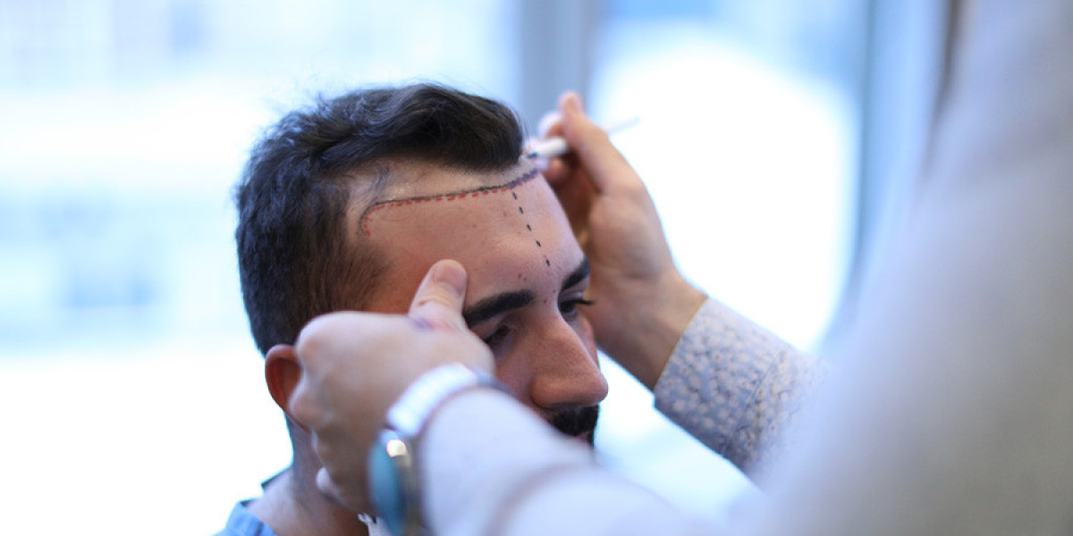 Hair Transplant Clinic Selection: What Islamabad Patients Often Overlook