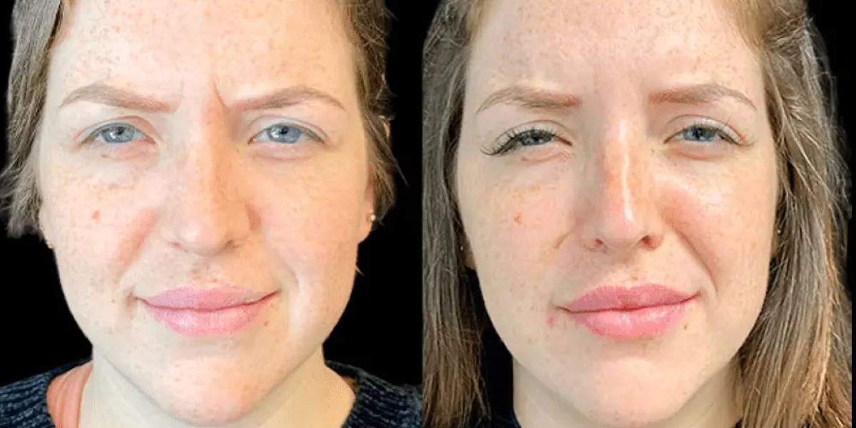 Best Plastic Surgeons in dubai for Botox Treatments for Crow’s Feet